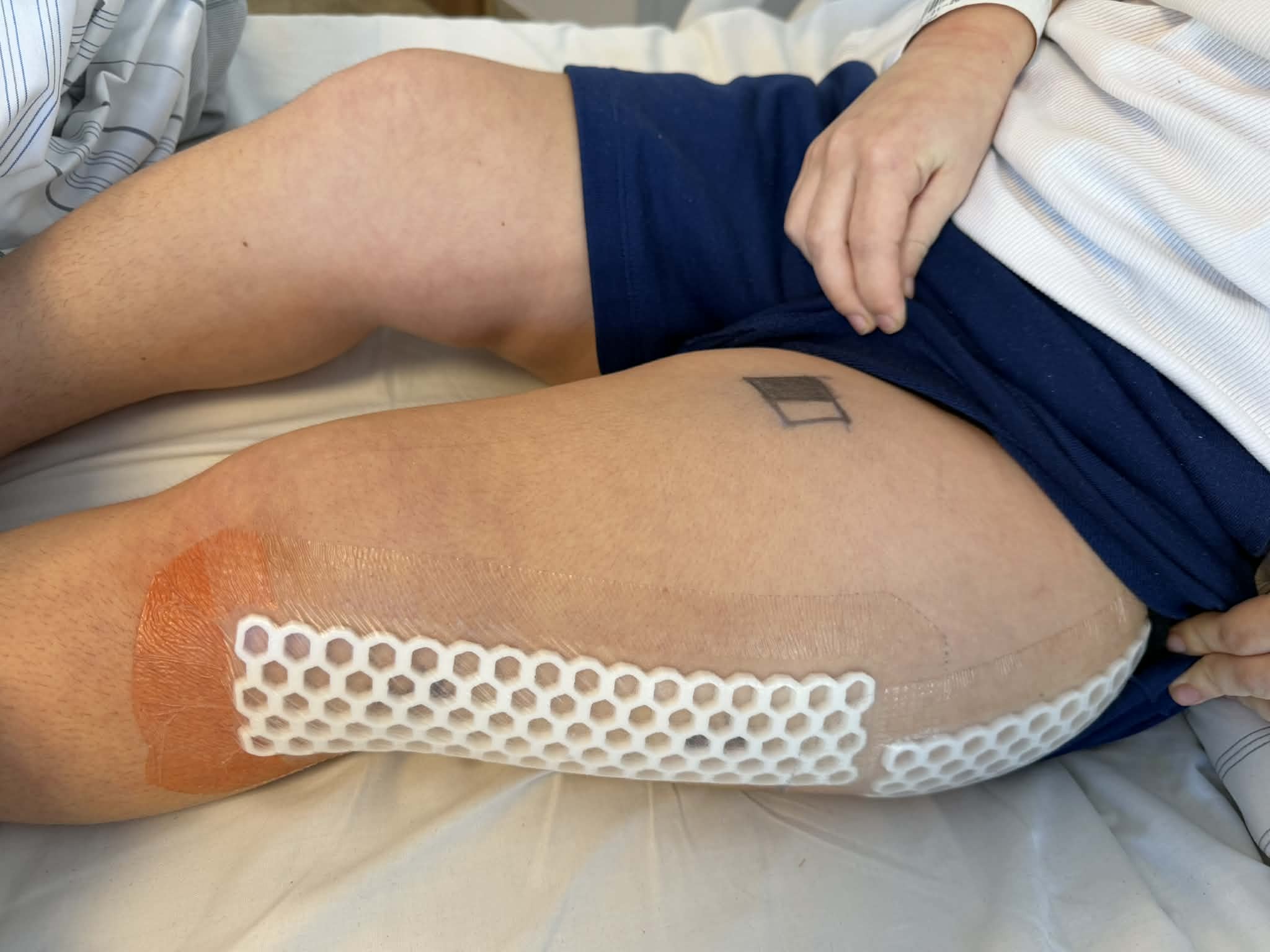 Lekarze w szpitalu w Chorzowie wszczepili do kości dziewczynki magnetyczny gwóźdź rosnący. Dzięki temu zabiegowi noga dziecka została wydłużona o 15 cm